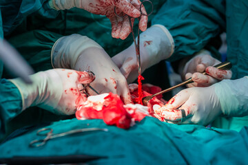 Surgeons in operating room treating tumor