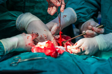 Surgeons in operating room treating tumor