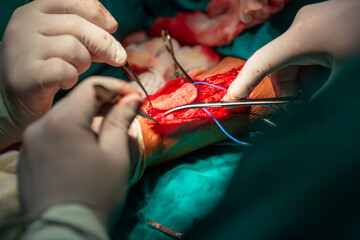 Open hand radial artery surgery in hospital