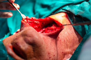 Carotid artery surgery in hospital