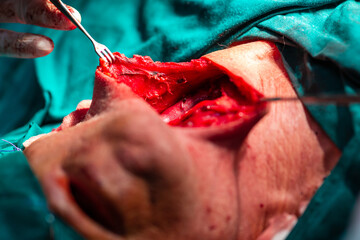 Carotid artery surgery in hospital
