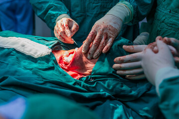 Carotid artery surgery in hospital