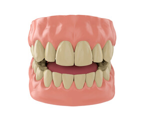 human Jaw with yellow teeth isolated on white, 3d render