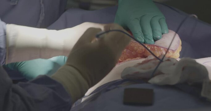 Close-up. the surgeon removes the breast body on the nipples. breast augmentation plastic surgery. Mammaplasty. breast cancer
