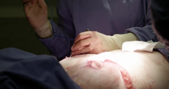 close-up. surgeon and his assistant suture the incisions under the mammary glands after removing the mammalian glands. breast augmentation plastic surgery. Mammaplasty. breast cancer.