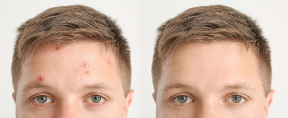 Teenage boy before and after acne treatment on light background, closeup