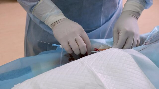 Preparation for coronary angiography. Doctor's hands insert a diagnostic catheter into the patient's vein. Close-up.