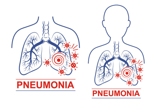 Pneumonia Disease Icon Set. Human Lungs And Trachea Anatomy. Treating For Pneumonia. Treatment For Coronavirus Or Bacterial Attack Of Respiratory System. Flat Vector For Medicine Packaging Design