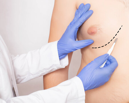 Doctor plastic surgeon with scalpel near male patient's chest. Male Breast and Nipple Reduction Concept, close-up