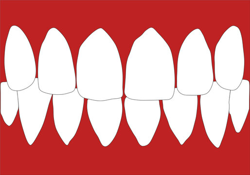 Dentures With White Teeth. The Gums Of The Upper And Lower Jaw Isolated On A White Background. Vector Illustration. Stomatology