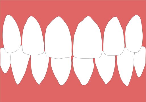 Dentures With White Teeth. The Gums Of The Upper And Lower Jaw Isolated On A White Background. Vector Illustration. Stomatology