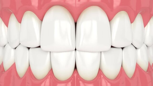 Human jaw with black triangles spaces between teeth