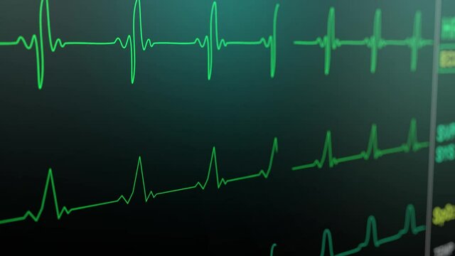 Heart rate monitor in hospital theater. Medical vital signs monitor instrument in a hospital on anesthesia surgery monitor. ECG. Patient heartbeat at the screen