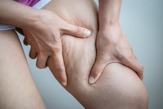 Woman with cellulite (known as orange-peel skin) problem appears on her legs. cellulite It forms when fatty tissue deep in the skin pushes up against connective tissue.