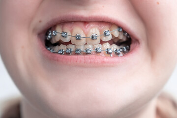 Close up of crooked teeth with braces.