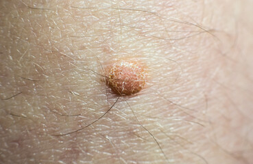 Big birthmark on skin. Medical health photo. Papillomas on human body.