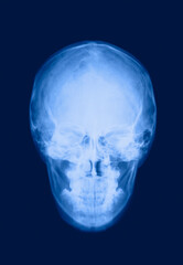 脳のレントゲン写真