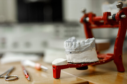 Plaster model of patients teeth.