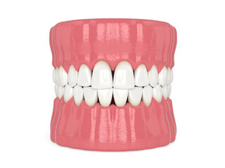 3d render of human jaw with black triangles