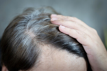 Naklejka premium A man has hair growth, he has hair loss problems. Dry scalp, dandruff