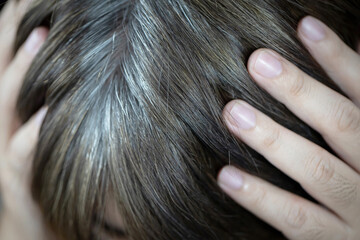 Obraz premium A man has hair growth, he has hair loss problems. Dry scalp, dandruff