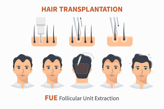 Type and stages of hair transplantation FUE Follicular Unit Extraction. Treatment of baldness, alopecia, mens hair loss. Vector medical infographics, a male head scalp. Strip, graft machine.