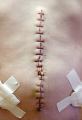 Surgical suture after abdominal cavity surgery, close - up view of surgical suture
