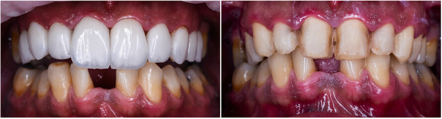 full upper jaw press ceramic veneers  © Garo
