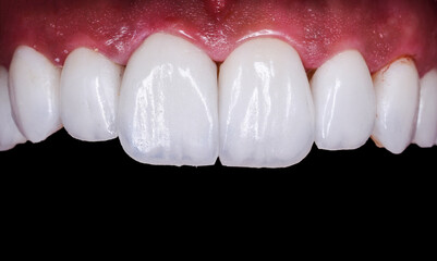 full upper jaw press ceramic veneers  © Garo