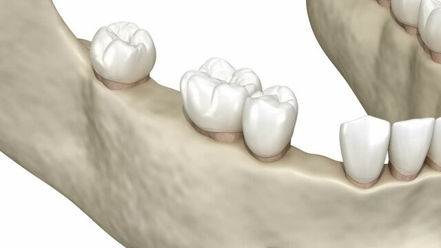 Teeth shift deformatiuon after losing teeth. 3D animation of Popov Godon phenomenon