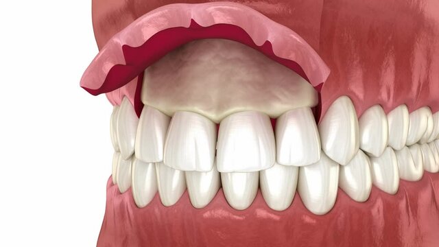 Frontal crown lengthening, Esthetic surgery. Medically accurate dental 3D animation