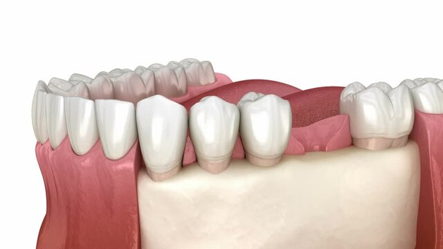 Dental implant instalation, custom abutment and ceramic crown. Medically accurate tooth 3D animation.