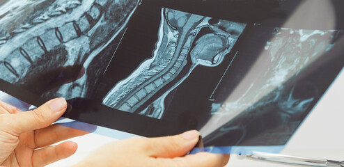 doctors hands holding x-ray or MRI medical imaging with a head and neck condition. Spinal cord,...