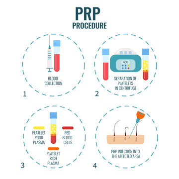 Platelet rich plasma procedure stages. PRP hair loss treatment steps. Alopecia infographic medical design template for transplantation clinics and diagnostic centers. Vector illustration.