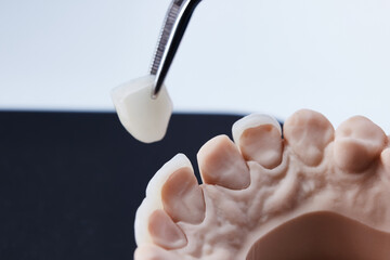 Ceramic dental veneers. Close-up view of dental layout of lower row of teeth prothesis on...