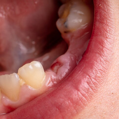 Close-up of a boy's milk tooth fell out.