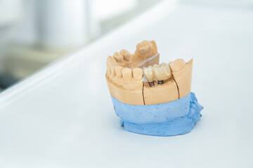 An artificial jaw with a ceramic crown on implants, stands on a table in a medical office. Dentistry and treatment concept