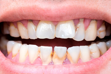 Fototapeta premium Tooth's a man smoking bad. Man smokes a cigarettes have tooth decay and calculus on teeth, So we should be care dental with the hygiene