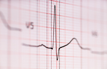 ECG graph