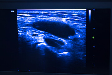 EPI dry needling ultrasound scan