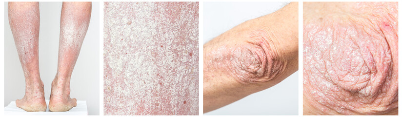 Panel Collage of acute psoriasis on the elbows and legs of a man - an autoimmune incurable dermatological skin disease. Large, red, sore, scaly rash on the elbows and legs.