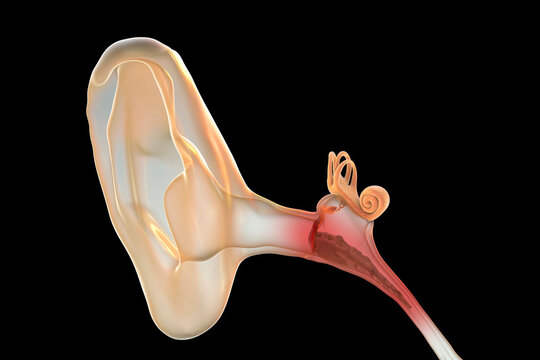 Otitis media, inflammatory disease of the middle ear