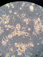 Human cancer cells  with nanoparticles under the microscope