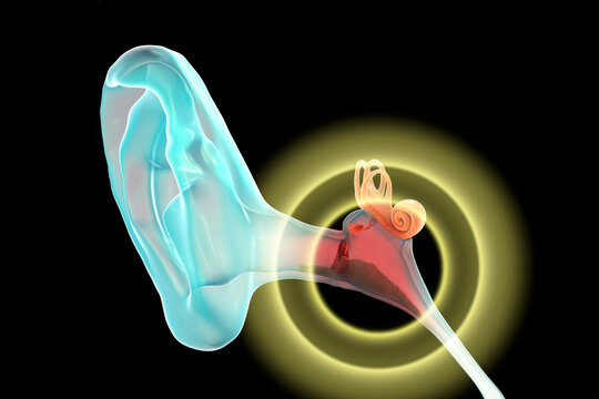 Otitis media, inflammatory disease of the middle ear