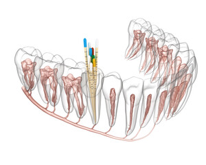 Obraz na płótnie Canvas Endodontic root canal treatment process. Medically accurate tooth 3D illustration.