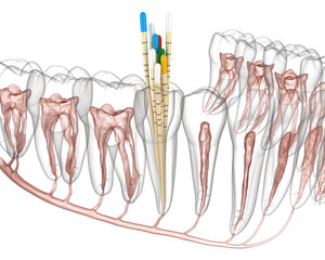 Obraz na płótnie Canvas Endodontic root canal treatment process. Medically accurate tooth 3D illustration.