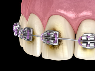 Caries process near braces as result by poor hygiene. Medically accurate 3D illustration of oral hygiene.