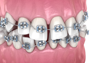 Abnormal teeth position and correction with metal braces tretament. Medically accurate dental 3D illustration