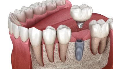 Molar tooth crown installation over implant abutment. Medically accurate 3D illustration of human teeth and dentures concept