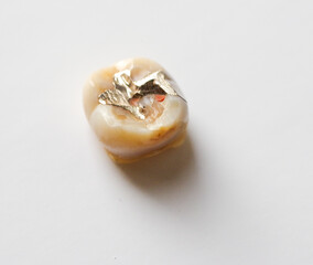 虫歯を治療した歯